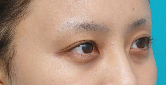 二重まぶた・ミニ切開法(部分切開),一重まぶたに対してミニ切開二重を行い自然な末広型二重を作った症例写真,After(メイクなし),ba_minisekkai26b_b.jpg