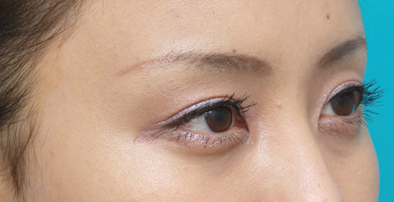 二重まぶた・ミニ切開法(部分切開),一重まぶたに対してミニ切開二重を行い自然な末広型二重を作った症例写真,After(メイクあり)<br/>
(3ヶ月後),