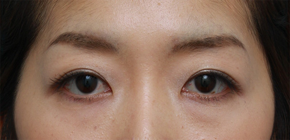 二重まぶた・ミニ切開法(部分切開),一重まぶたをミニ切開法で狭くて自然な末広型二重にした症例写真,After(メイクあり)<br/>
(2ヶ月後),