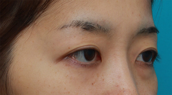 二重まぶた・ミニ切開法(部分切開),一重まぶたをミニ切開法で狭くて自然な末広型二重にした症例写真,After(メイクなし),ba_minisekkai28b_b.jpg