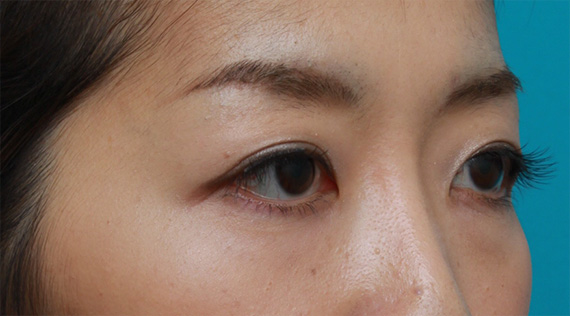 二重まぶた・ミニ切開法(部分切開),一重まぶたをミニ切開法で狭くて自然な末広型二重にした症例写真,After(メイクあり)<br/>
(2ヶ月後),