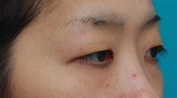 二重まぶた・ミニ切開法(部分切開),一重まぶたをミニ切開法で狭くて自然な末広型二重にした症例写真,Before,ba_minisekkai28b_b.jpg