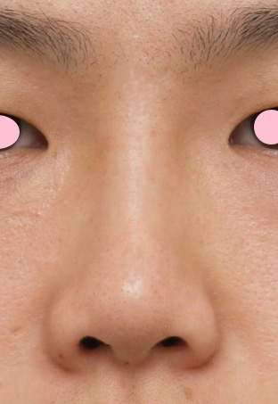 症例写真,隆鼻術(シリコンプロテーゼ)の症例 鼻筋が通っていない貧弱さが悩みの20代男性,After(1週間後),ba_ryubi17_b.jpg