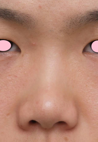 症例写真,隆鼻術(シリコンプロテーゼ)の症例 鼻筋が通っていない貧弱さが悩みの20代男性,Before,ba_ryubi17_b.jpg