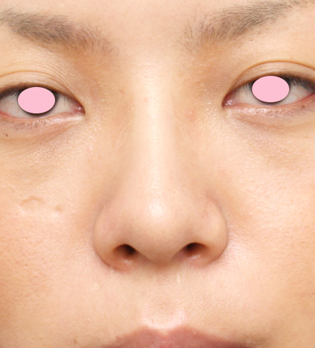 症例写真,隆鼻術(シリコンプロテーゼ)の症例 鼻先が上に向いたブタ鼻のように見えていた20代女性,After(1週間後),ba_ryubi14_b.jpg