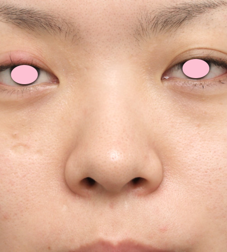 症例写真,隆鼻術(シリコンプロテーゼ)の症例 鼻先が上に向いたブタ鼻のように見えていた20代女性,Before,ba_ryubi14_b.jpg