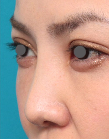 他院で受けた手術の修正(鼻),他院で受けた鼻の手術の修正症例写真,After,ba_ryubi31_b.jpg