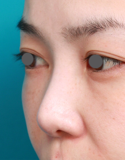 他院で受けた手術の修正(鼻),他院で受けた鼻の手術の修正症例写真,Before,ba_ryubi31_b.jpg