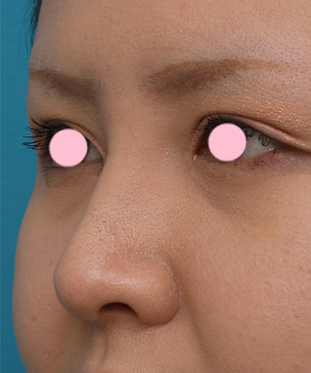 症例写真,3mmの鼻シリコンプロテーゼを入れた症例写真,After(1週間後),ba_ryubi33_b.jpg