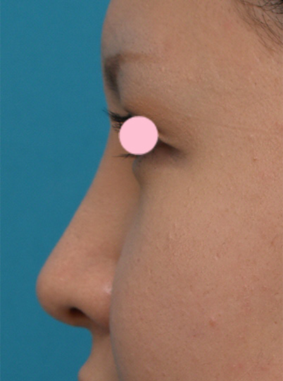 症例写真,3mmの鼻シリコンプロテーゼを入れた症例写真,After(1週間後),ba_ryubi34_b.jpg