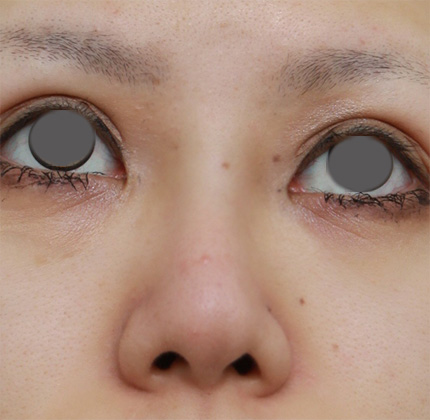 症例写真,他院で入れたL型プロテーゼをI型プロテーゼに入れ替えて修正した症例写真,After(2ヶ月後),ba_ryubi39_b.jpg