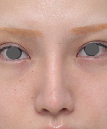 症例写真,鼻にヒアルロン酸が入っている方に、プロテーゼ+耳介軟骨移植+鼻翼縮小を行った症例写真,After(メイクあり),