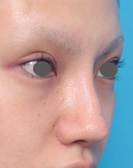 症例写真,鼻にヒアルロン酸が入っている方に、プロテーゼ+耳介軟骨移植+鼻翼縮小を行った症例写真,After(メイクなし),ba_ryubi41_b.jpg