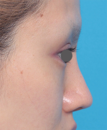 症例写真,鼻にヒアルロン酸が入っている方に、プロテーゼ+耳介軟骨移植+鼻翼縮小を行った症例写真,After(メイクなし),ba_ryubi42_b.jpg