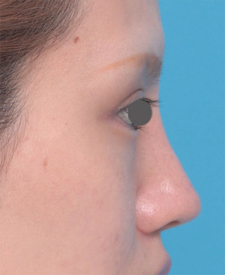 症例写真,鼻にヒアルロン酸が入っている方に、プロテーゼ+耳介軟骨移植+鼻翼縮小を行った症例写真,After(メイクあり),