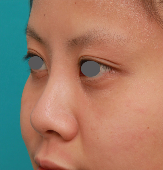 症例写真,顔の印象をあまり変えないように鼻にシリコンプロテーゼを入れた症例写真,After(1年後),ba_ryubi63_b.jpg