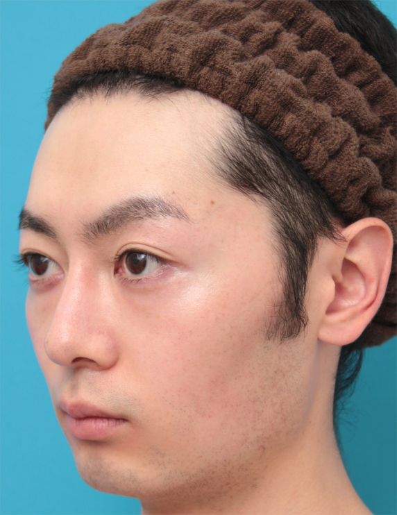 症例写真,眉間~鼻筋にかけてのシリコンプロテーゼ+ボツリヌストキシン注射(エラ、プチ小顔術)をした20代男性の症例写真,After(6ヶ月後),ba_ryubi71_b.jpg