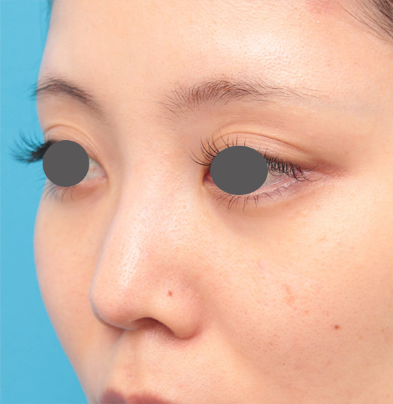 鼻翼縮小(小鼻縮小),鼻のヒアルロン酸を分解して、同時にシリコンプロテーゼと小鼻縮小をした症例写真の術前術後画像,Before,ba_ryubi73_b.jpg