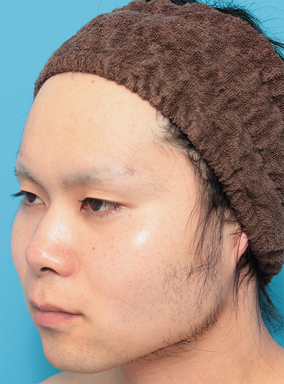 症例写真,鼻のヒアルロン酸注射+耳介軟骨移植+小鼻(鼻翼)縮小+ボツリヌストキシン注射(エラ、プチ小顔術)をした症例写真,Before,ba_ryubichusha41_b.jpg
