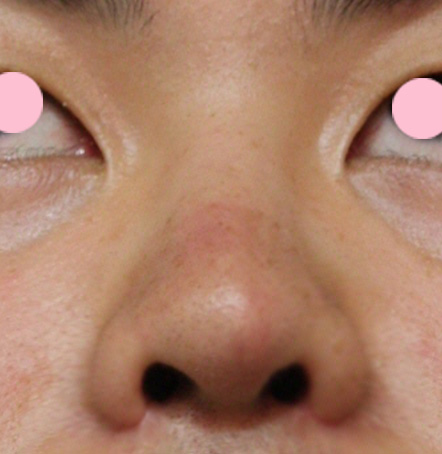 症例写真,鼻翼縮小(小鼻縮小)の症例写真 上向きで大きい鼻の穴,After,ba_biyoku17_b.jpg