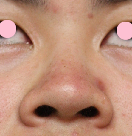 症例写真,鼻翼縮小(小鼻縮小)の症例写真 上向きで大きい鼻の穴,Before,ba_biyoku17_b.jpg