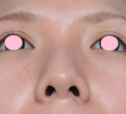 症例写真,鼻翼(小鼻)縮小+鼻のヒアルロン酸注射症例写真,Before,ba_biyoku20_b.jpg