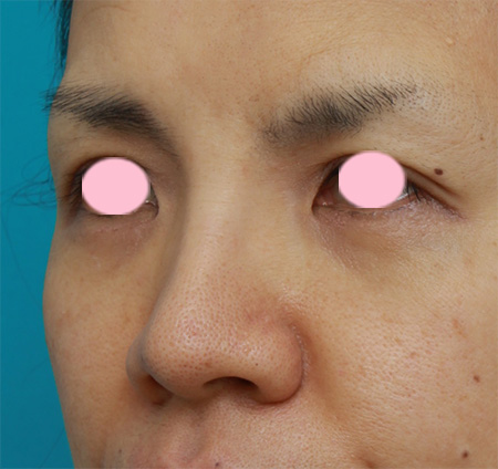 症例写真,鼻翼(小鼻)縮小で、鼻の穴の内側から外側にかけて大きく切開した症例写真,Before,ba_biyoku27_b.jpg