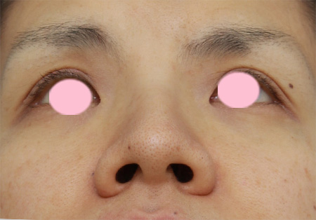 症例写真,鼻翼(小鼻)縮小で、鼻の穴の内側から外側にかけて大きく切開した症例写真,Before,ba_biyoku28_b.jpg