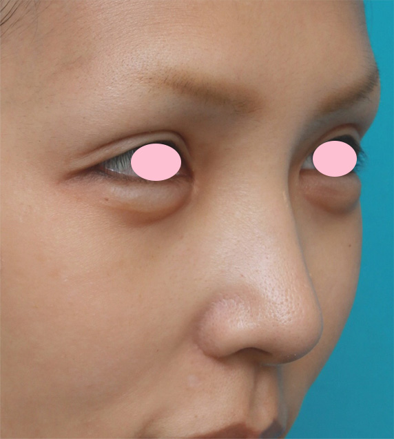 症例写真,鼻翼(小鼻)縮小手術で、自然な範囲内で最大限小鼻を小さくした症例写真,After(3ヶ月後),ba_biyoku30_b.jpg