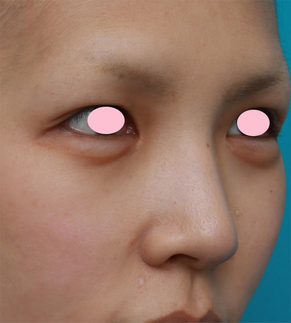 症例写真,鼻翼(小鼻)縮小手術で、自然な範囲内で最大限小鼻を小さくした症例写真,Before,ba_biyoku30_b.jpg