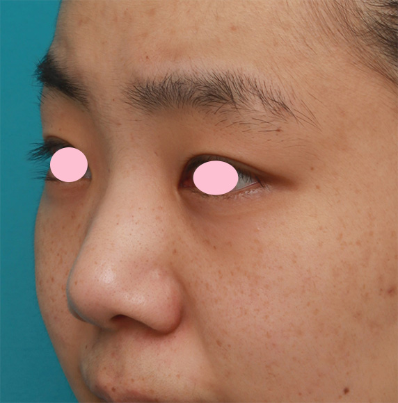 症例写真,鼻尖縮小(鼻尖形成)+小鼻縮小(鼻翼縮小)で大きな鼻を小さくすっきりさせた症例写真の術前術後画像,Before,ba_biyoku39_b.jpg