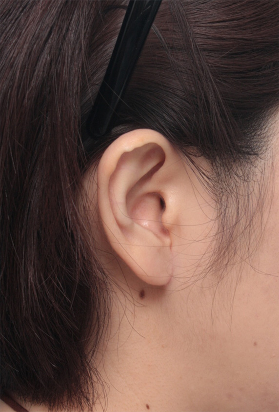 その他の耳の手術,大きい耳たぶを傷痕を目立たせず小さく修正手術した症例写真,After（4ヶ月後）,ba_mimiother09_a01.jpg