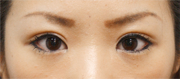 二重まぶた・全切開法,二重まぶた・全切開法の症例 術後1ヶ月経過した20代女性,After(メイクあり)<br/>
(1ヶ月後),