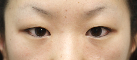 二重まぶた・全切開法の症例 術後1ヶ月経過した20代女性,Before,ba_sekkai11_b.jpg