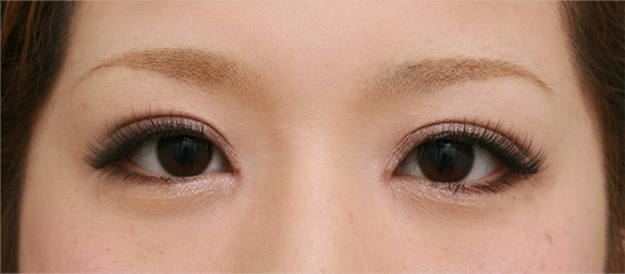 症例写真,二重まぶた・全切開法の症例 目頭切開も施行,After(メイクあり),