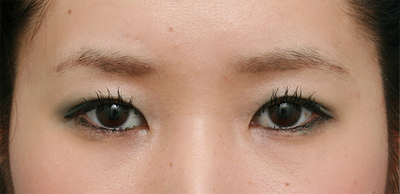 症例写真,二重まぶた・全切開法の症例 まぶたに脂肪が多く腫れぼったい目だった女性,After(メイクあり)<br/>
(3ヶ月後),