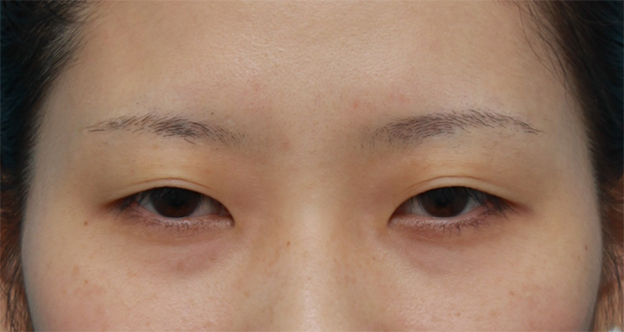 二重まぶた・ミニ切開法（部分切開）,目頭切開せずに二重まぶたミニ切開法で幅の狭い平行型二重を作った症例写真,手術前,mainpic_mini_sekkai16a.jpg