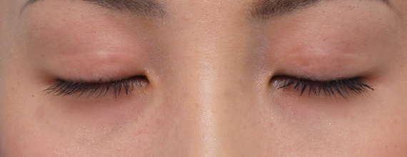 症例写真,二重まぶた・全切開法の症例 まぶたの上に不自然なクセができていた女性,After(目を閉じた状態)<br/>
(6ヶ月後),