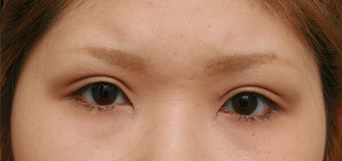 症例写真,かなり厚ぼったい一重まぶたに全切開法をして、幅広平行型二重にした症例写真,3ヶ月後,メイクあり,mainpic_sekkai03d.jpg