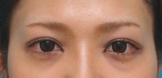 二重まぶた・全切開法,目頭切開+全切開二重でやや幅の広い平行型二重を作った症例写真,After(メイクあり)<br/>
(3ヶ月後),