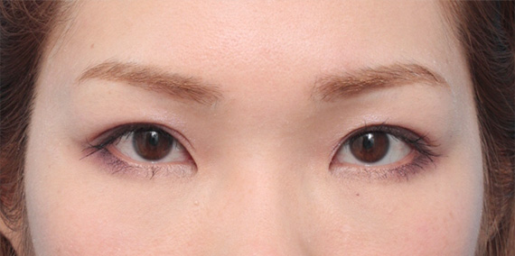 症例写真,全切開法で非常に狭い平行型二重を作った症例写真,After(メイクあり)<br/>
(6ヶ月後),