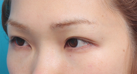 症例写真,全切開法で非常に狭い平行型二重を作った症例写真,After(メイクなし),ba_sekkai22_b.jpg