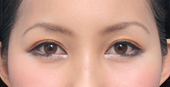 症例写真,全切開法で平行型二重を作った症例写真,After(メイクあり)<br/>
(6ヶ月後),