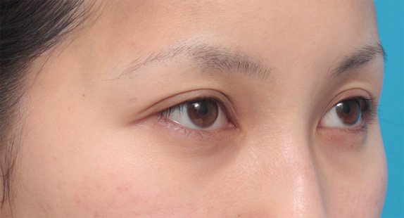 症例写真,全切開法で平行型二重を作った症例写真,After(メイクなし),ba_sekkai24_b.jpg