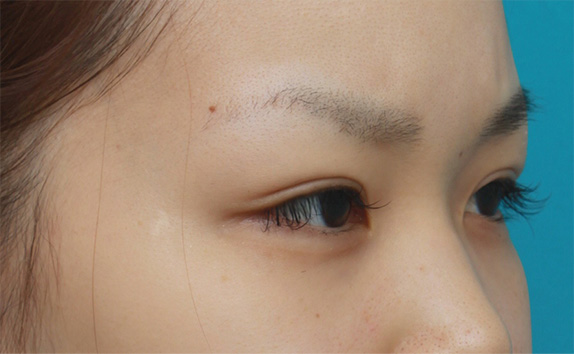 二重まぶた・全切開法,二重まぶた・全切開法の症例 術前は完全な一重まぶただった20代女性,After(メイクなし),ba_sekkai28_b.jpg