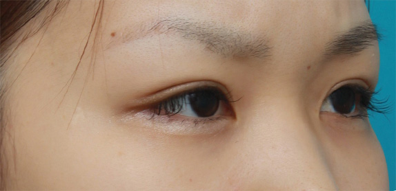 二重まぶた・全切開法,二重まぶた・全切開法の症例 術前は完全な一重まぶただった20代女性,After(メイクあり)<br/>
(6ヶ月後),