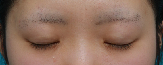 症例写真,他院で行った二重まぶた全切開法に対して、再び全切開法をして二重の幅を広く修正した症例写真,After(メイクなし・目を閉じた状態),