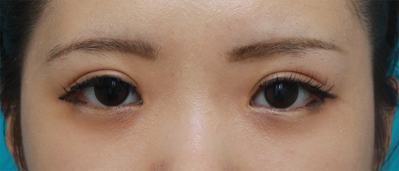症例写真,他院で行った二重まぶた全切開法に対して、再び全切開法をして二重の幅を広く修正した症例写真,After(メイクあり)<br/>
(6ヶ月後),