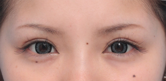 症例写真,他院で二重まぶた全切開法を受けた後、全切開法で修正した症例写真,After(メイクあり)<br/>
(6ヶ月後),