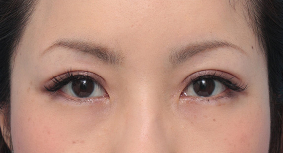 二重まぶた・全切開法,患者様の希望で、かなり幅の広い平行型二重を全切開法で作った症例写真,After(メイクあり)<br/>
(6ヶ月後),